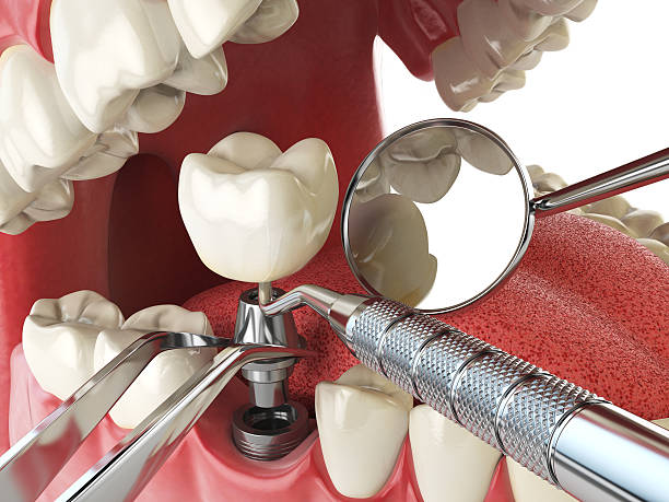 Best Tooth Infection Emergency Dentist  in Stansberry Lake, WA